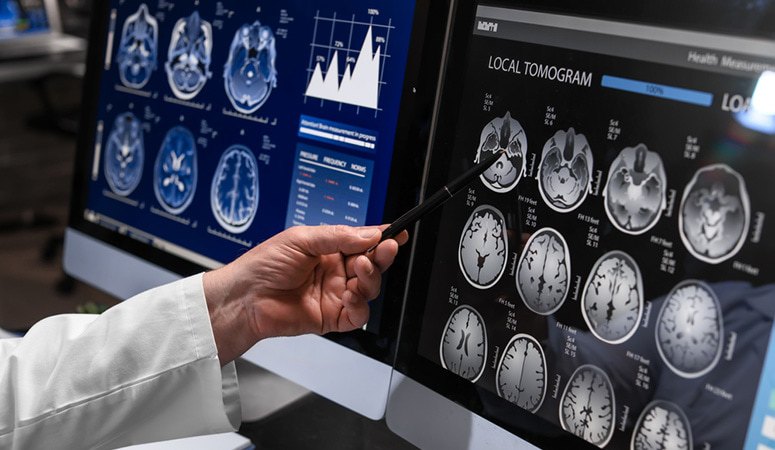 clario-alzheimers-aria-assessment
