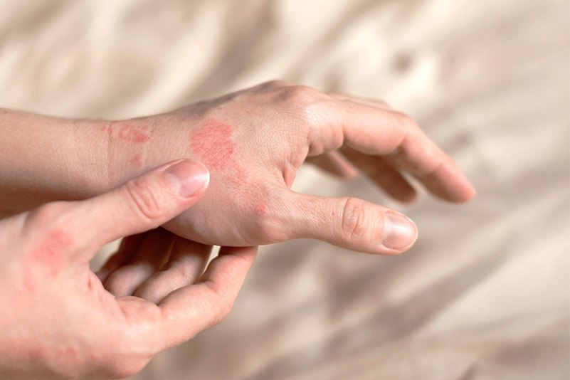 Chronic Hand Eczema Registry patient