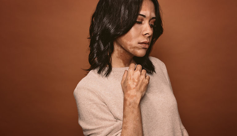 Vitiligo Dermatology Registries