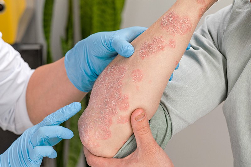 Generalized Pustular Psoriasis (GPP) Registry patient